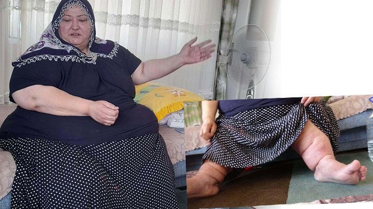 200 kiloya ulaşan fil hastası kadın, 7 yıldır evden çıkamıyor
