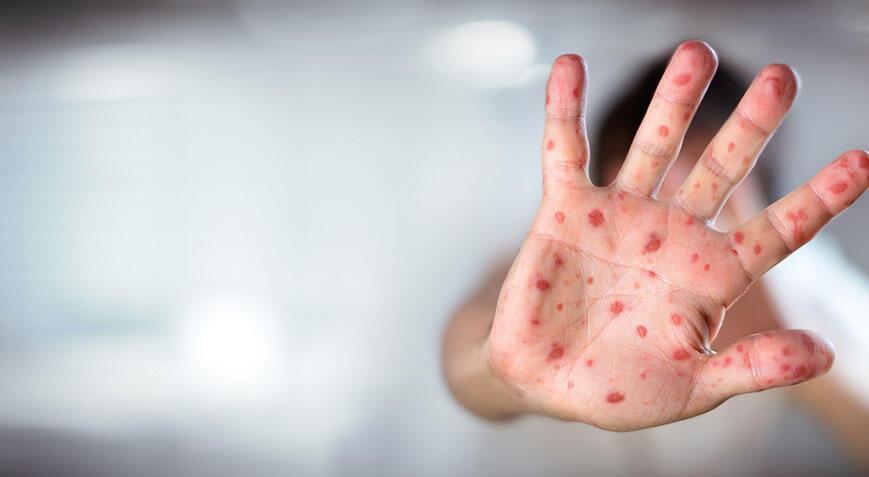 Kızamık tehlikesi devam ediyor! Uzman isim artışın sebebini açıkladı